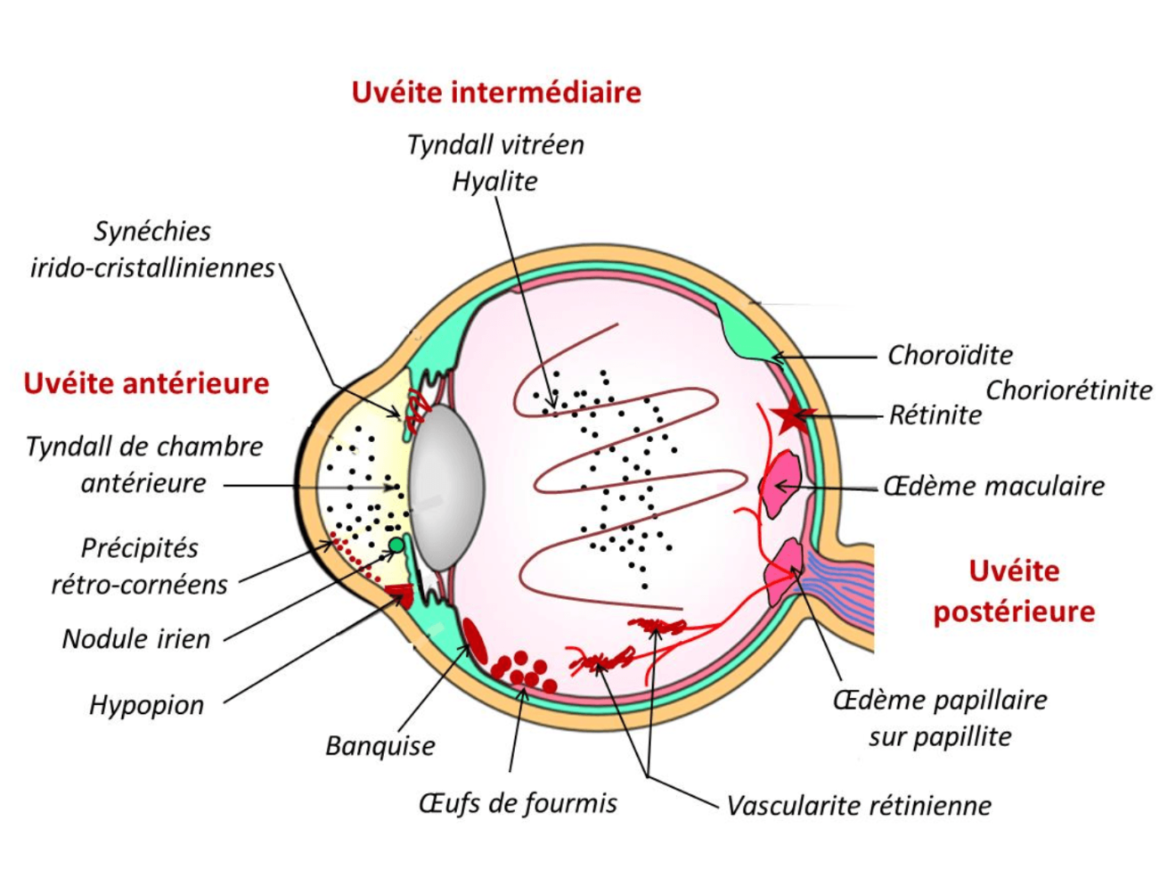 L'uvéite chez l'Homme – GMIO