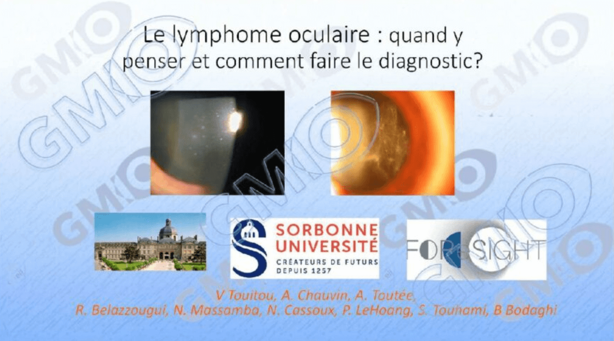 Le lymphome oculaire : quand y penser et comment faire le diagnostic ...